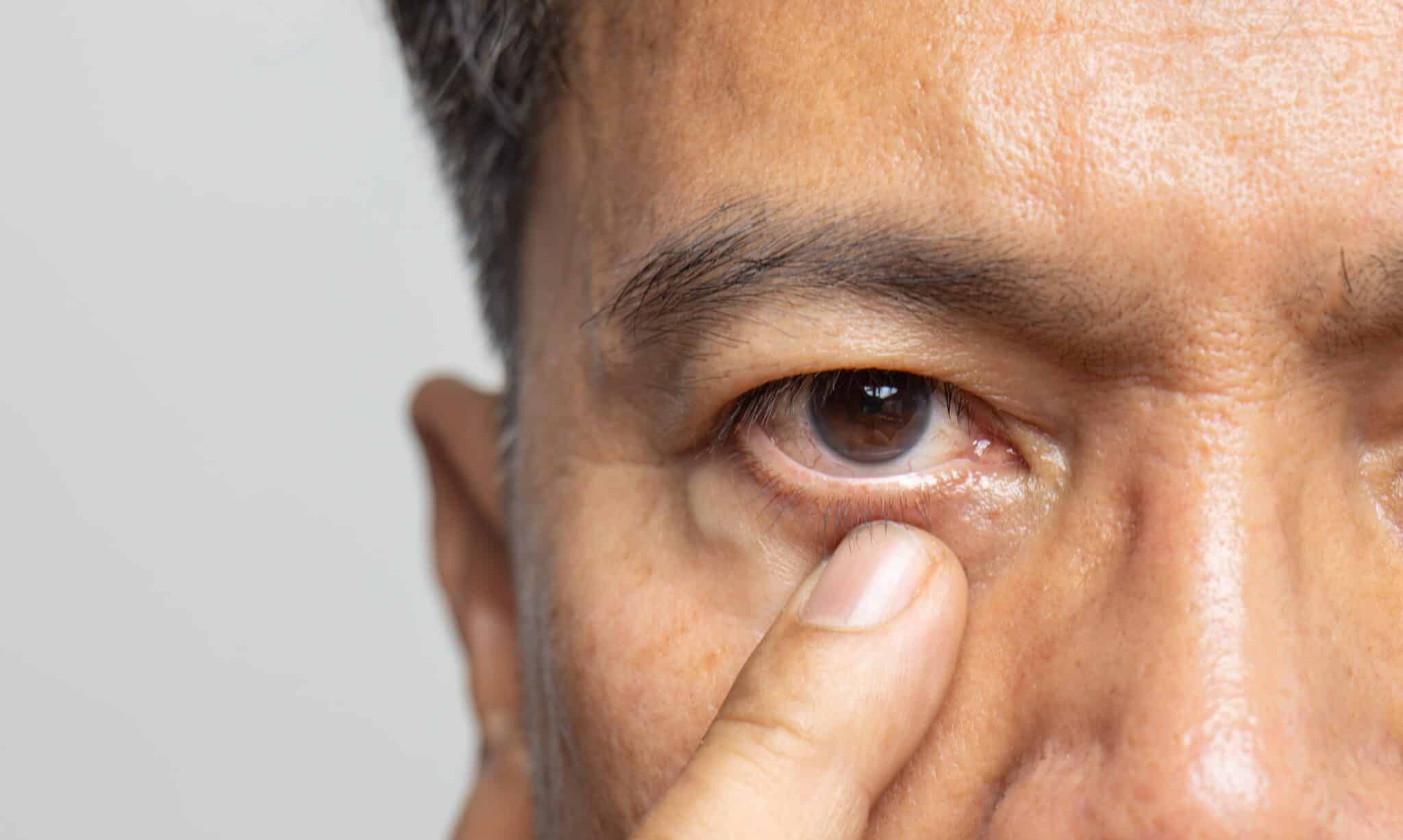 How To Treat Eye Twitching Blepharospasm 9867